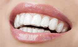 clear-aligners