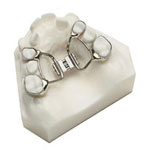 palatal expander